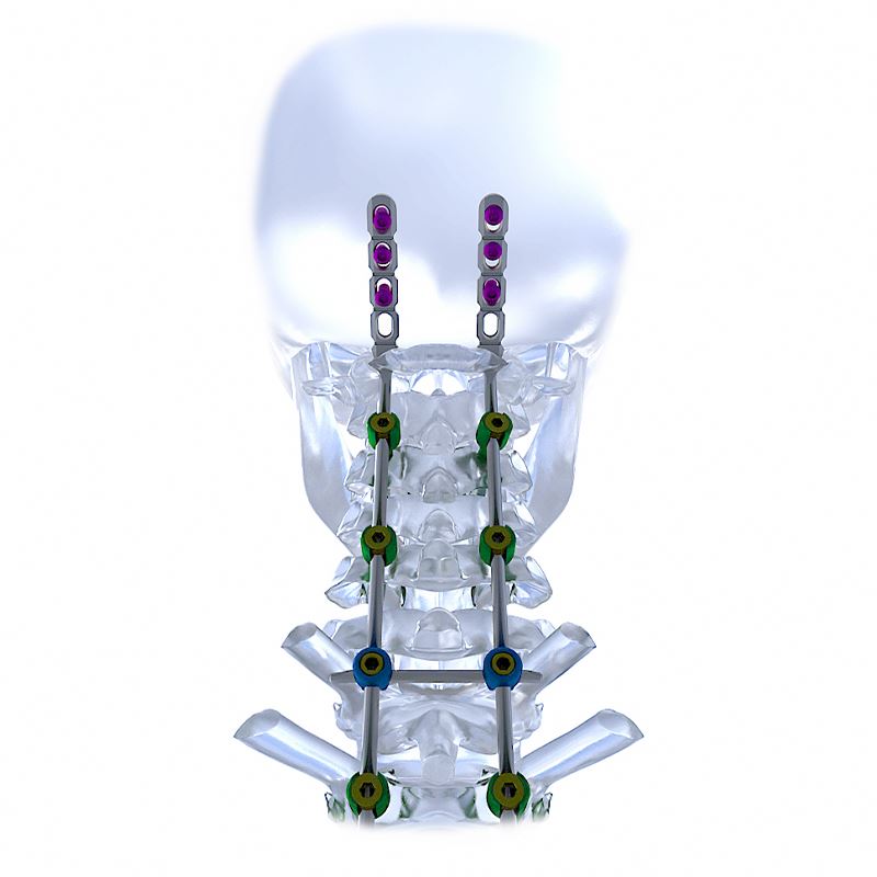 Fule Made in China High Quality Titanium Medical Devices Anterior Cervical Spine Plate System Class III with 5+ Year Warranty