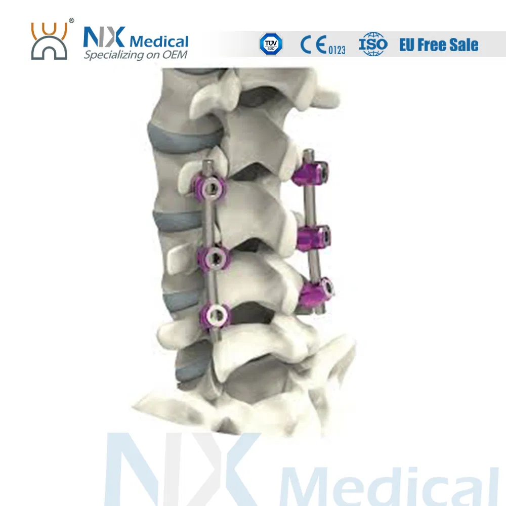 نظام برغي العمود الفقري لنظام زراعة العظام Nx Medical 6.0mm