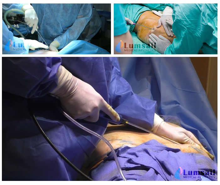 آلة شفط الدهون المعززة بالطاقة لجراحة التجميل مع زراعة الدهون