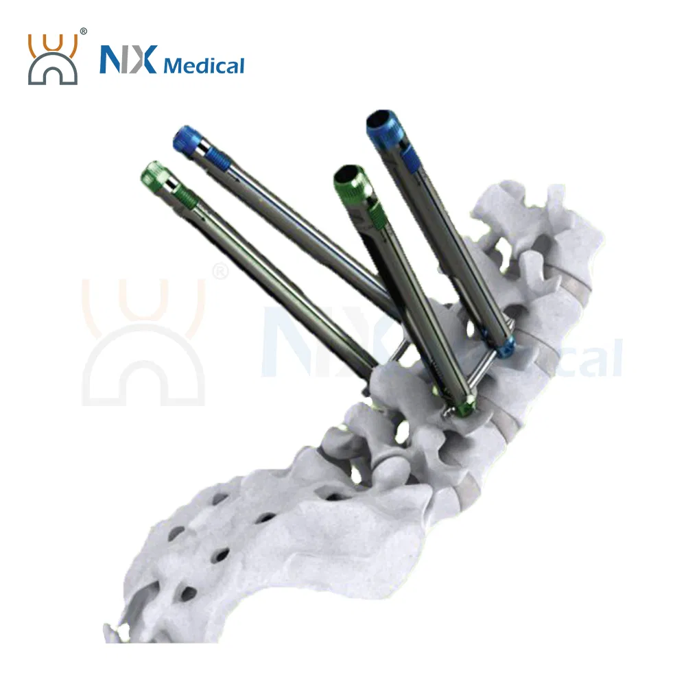 نظام تثبيت العظام الطبي Nx، براغي عمود فقري مثقوبة، أسمنت عظام داخلي، دعم تصنيع حسب الطلب
