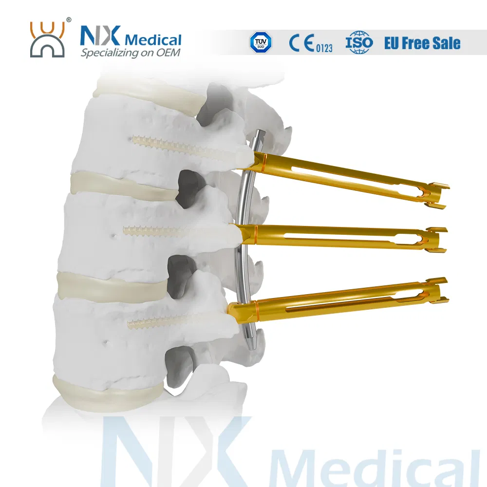 نظام برغي العمود الفقري المثقوب من Nx Medical للأطراف الاصطناعية العظمية مع الأسمنت العظمي 5.5mm