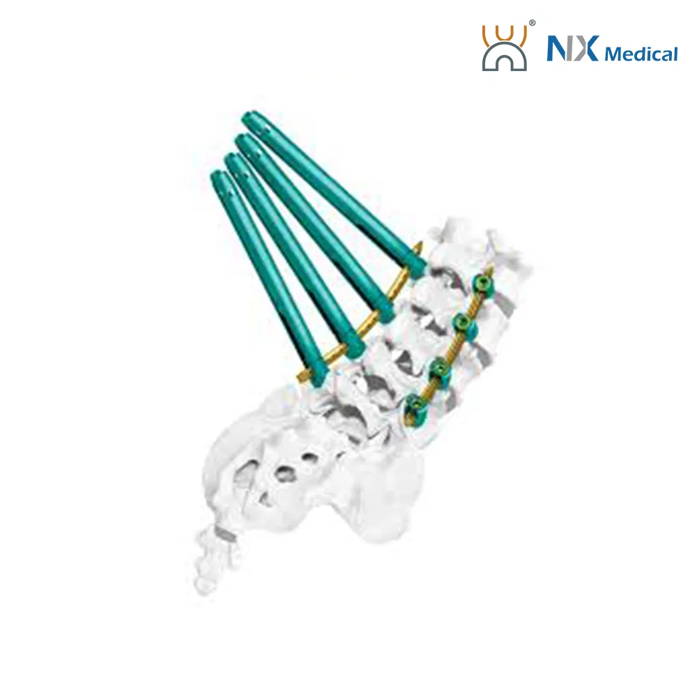 دعم تصنيع المعدات الأصلية من Nx Medical برغي عمود فقري من التيتانيوم مع تجويف داخلي للأسمنت العظمي