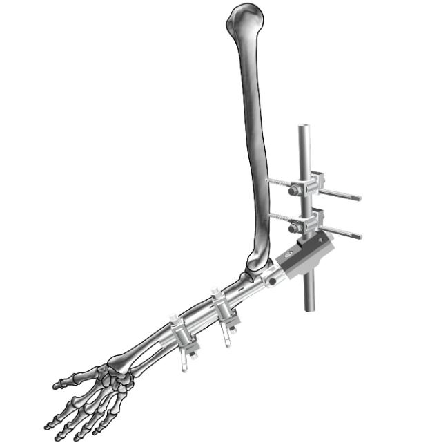 تصميم جهاز تثبيت خارجي محوري ديناميكي من نوع T للأجهزة الطبية orthopedics