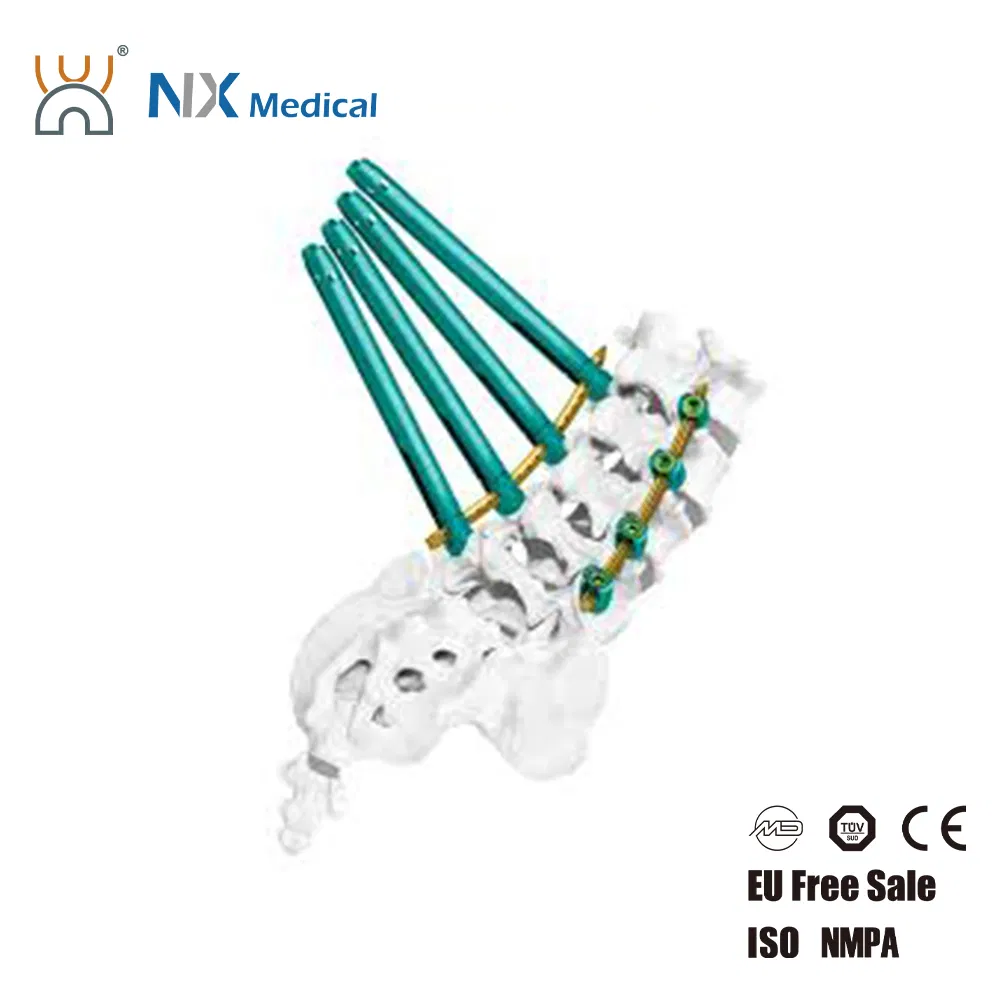 دعم تصنيع المعدات الأصلية من Nx Medical برغي عمود فقري من التيتانيوم مع تجويف داخلي للأسمنت العظمي