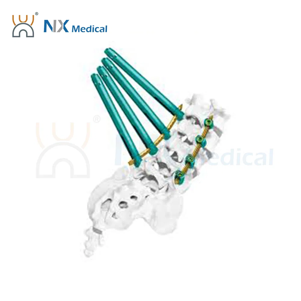 نظام تثبيت العظام الطبي Nx، براغي عمود فقري مثقوبة، أسمنت عظام داخلي، دعم تصنيع حسب الطلب