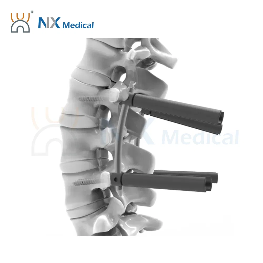 دعم تصنيع المعدات الأصلية من Nx Medical برغي عمود فقري من التيتانيوم مع تجويف داخلي للأسمنت العظمي