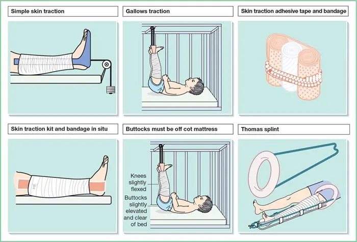 Skin Traction Kit Detail