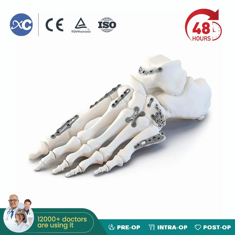 Titanium Orthopedic Implants Mini Bone Locking Plate for Foot and Ankle System