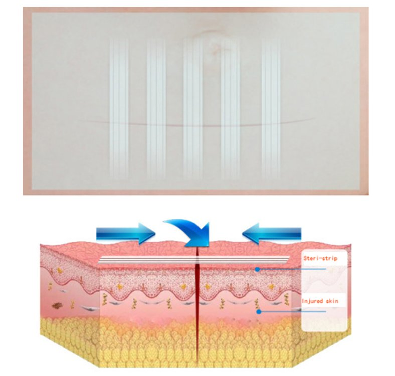3*75mm Medical Adhesive Tape Sterile Skin Closure Tape Best Price Superior Quality Wound Skin Closure Steri-Strip