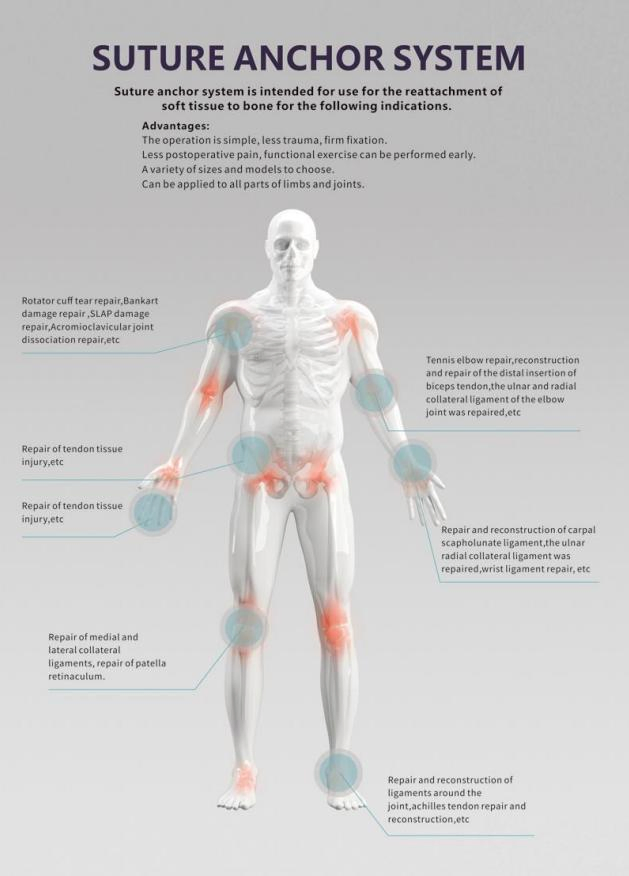 Implantation Sports Medicine Suture Anchor Instrument Set for Ligament Repair Suture Anchor System