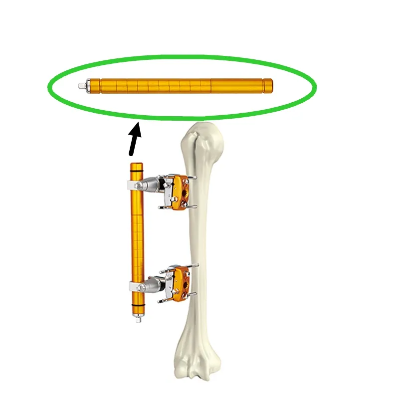 External Fixator Detail 1