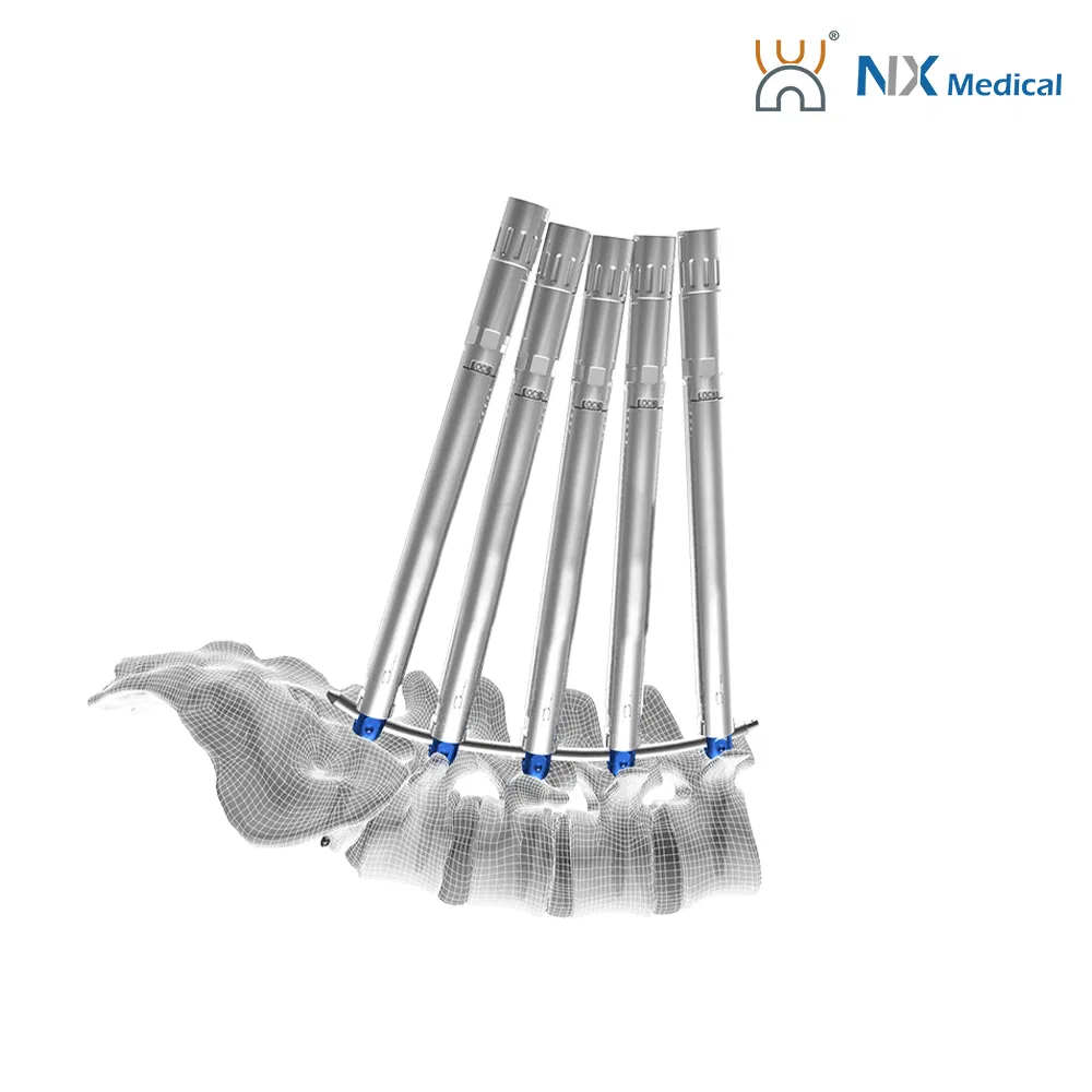 Nx Medical Titanium Cannulated Bone Cement Spinal Pedicle Screw Minimium Invasive