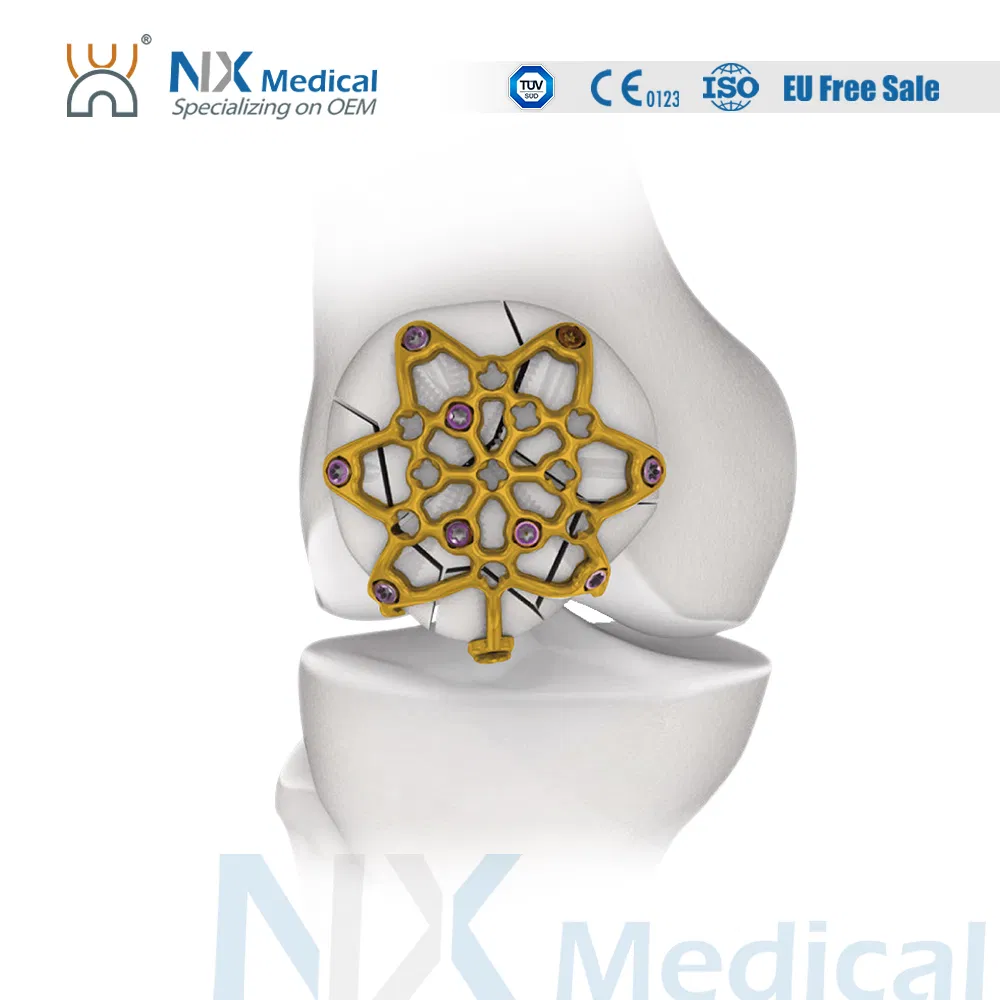 Nx Medical Orthopedic Trauma Variable Angle Patella Locking Plate System for Trauma Fixation