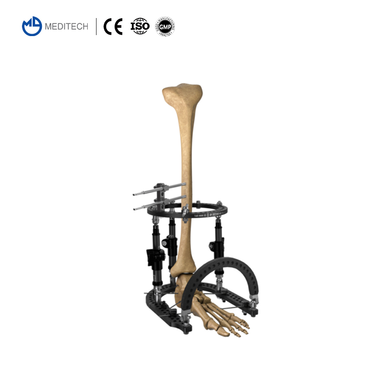 Orthopaedic Instruments Ilizarov Ring External Fixator for Tibial &amp; Femur Fracture