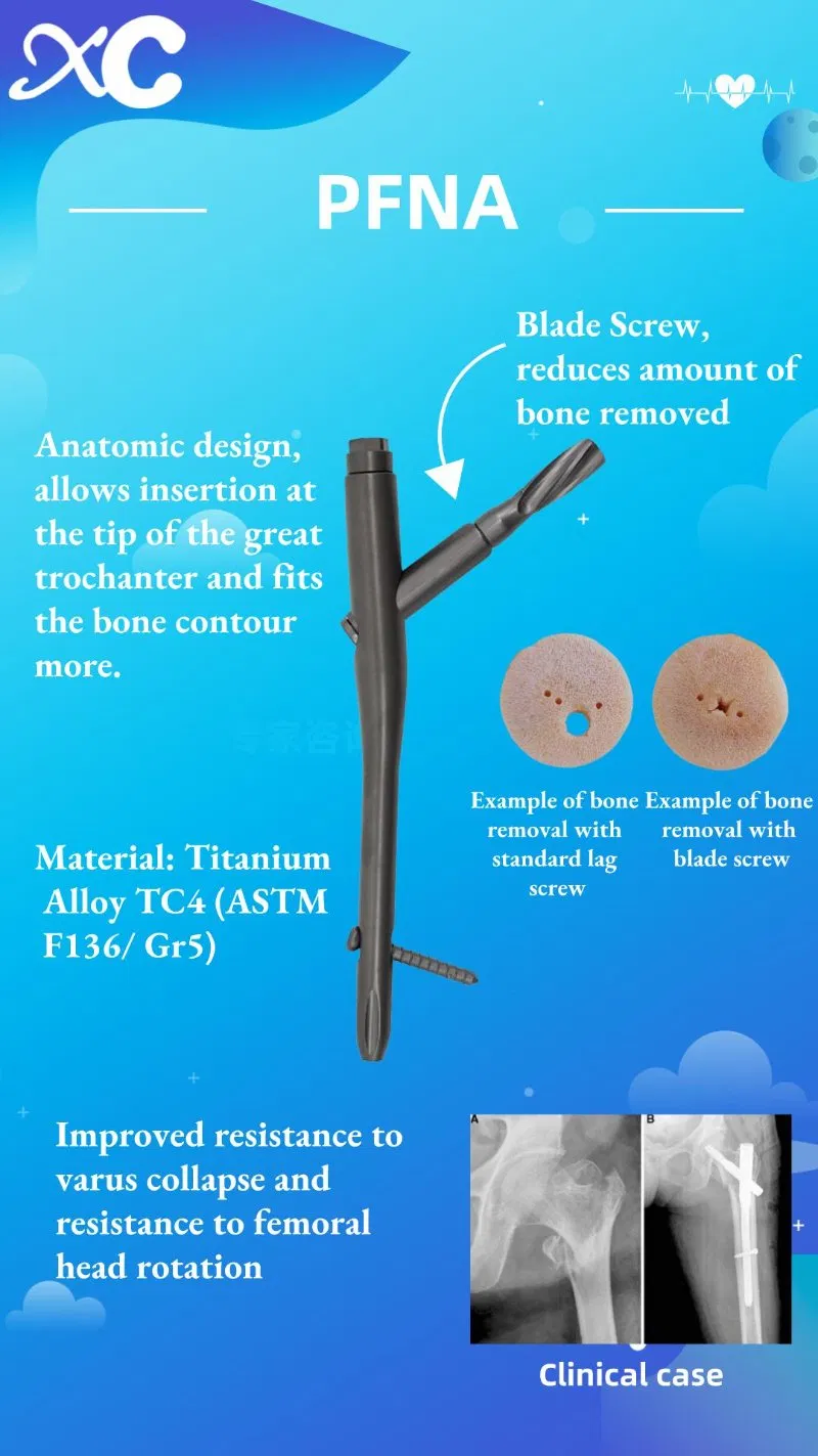 Orthopedic Implants Surgical Femoral PFNA