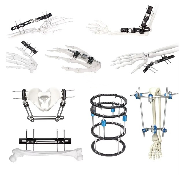 External Fixator Hand Bone Pin Stent Radius Mini Fixator Medical Equipment