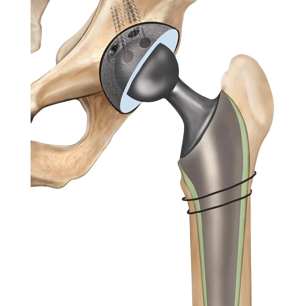 Cocrmo Alloy Total Knee Replacement Investment Casting for Medical Hip Implants