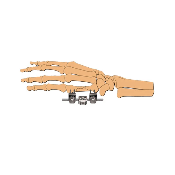 Orthopedic Surgical Mini-Horizontal Axis External Fixator