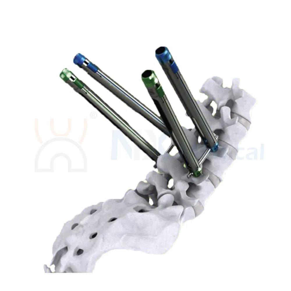 Nx Medical Titanium Cannulated Bone Cement Pedicle Screw 5.5mm Orthopedic Internal Fixation