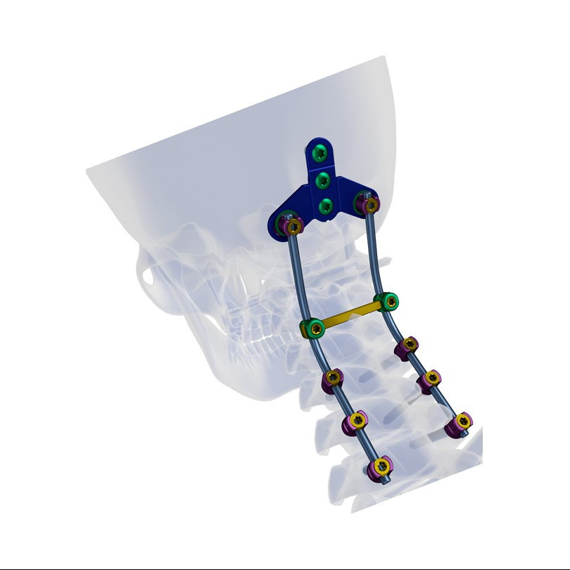 Pedicle Screw Fixation System Orthopaedic Spinal Implants Posterior Cervical Surgery Orthopedic Spine Surgical Instruments Set