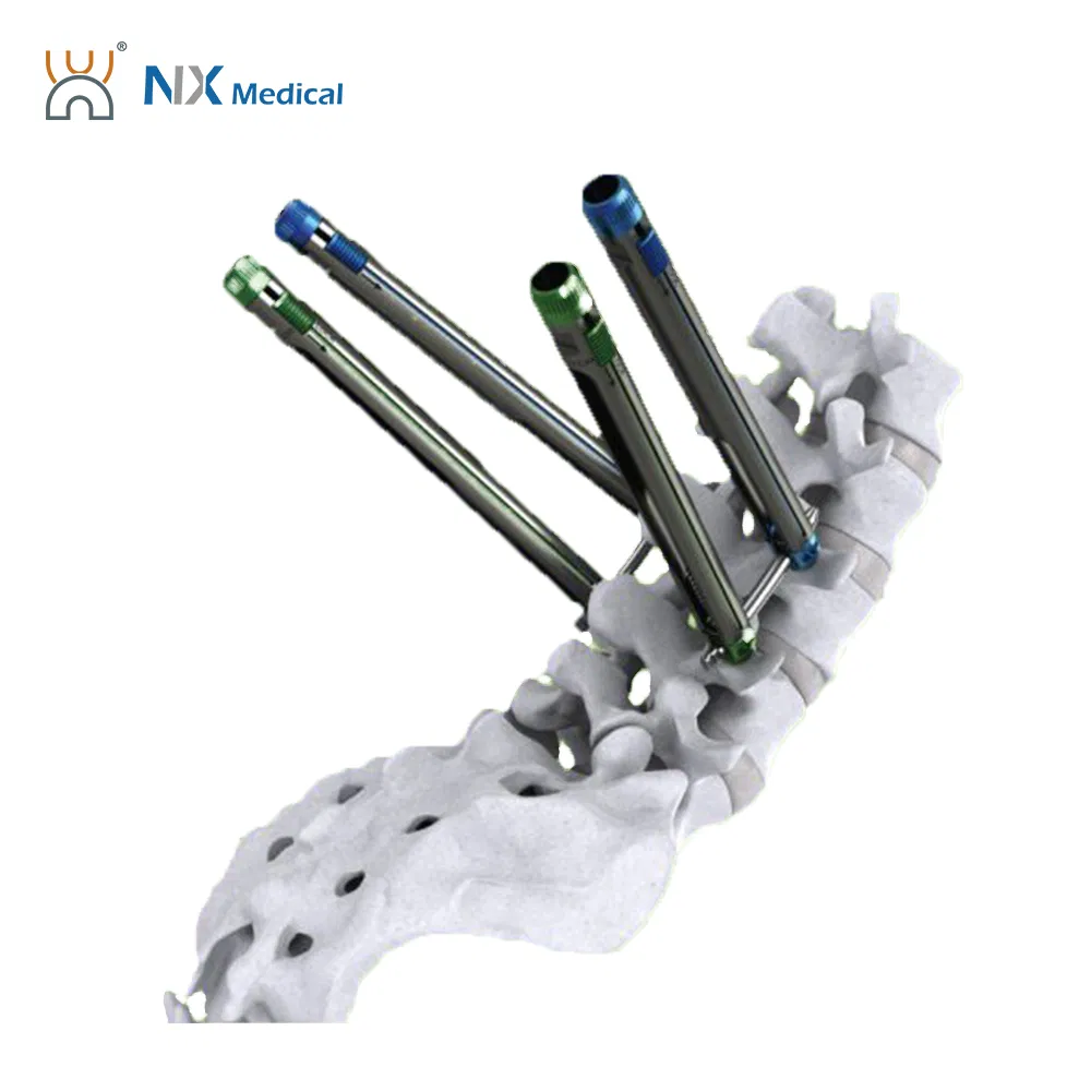 Nx Medical Spine Cannulated Bone Cement Pedicle Screw 5.5mm System Orthopedic Implant