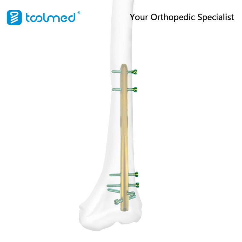 Orthopaedic Implant Trauma Expert-Level Femoral Retrograde Intramedullary Nail