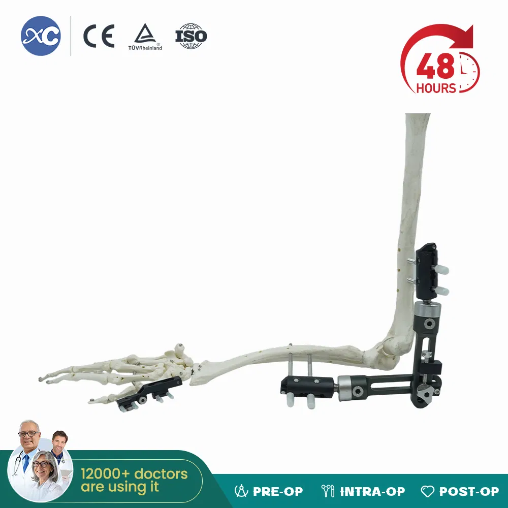 Elbow External Fixator Medium Tubular Bones Fracture Fixation Elbow Hinge Fixator