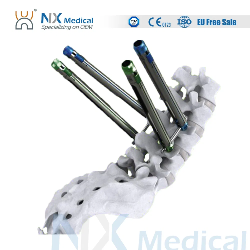 Nx Medical Orthopedic Implant Cannulated Bone Cement Pedicle Screw Spine Internal Fixation