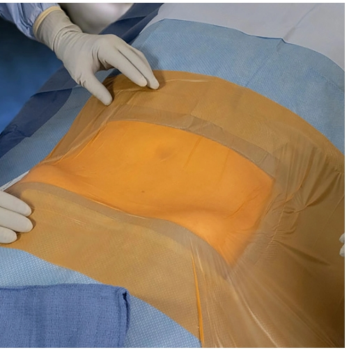 Disposable Waterproof Sterile Antimicrobial Iodine Surgical Incise Drape Film for Hospital Medical Supply