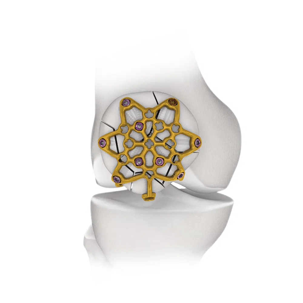 Nx Medical Variable Angle Patella Locking Compression Plate System Orthopedic Implant