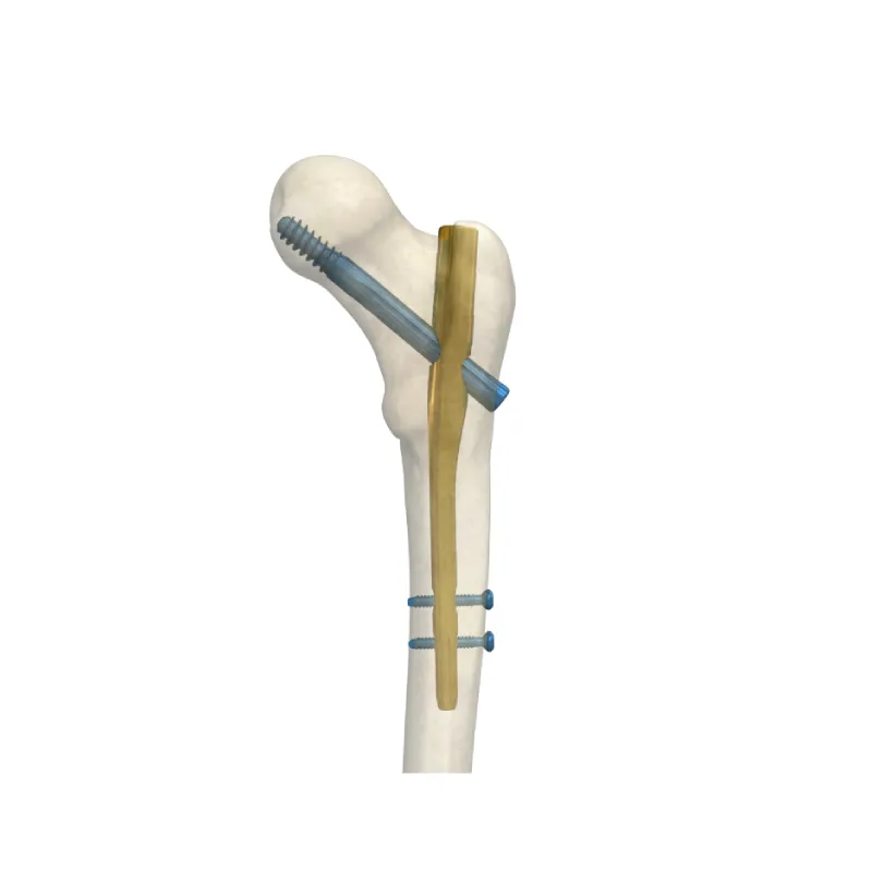 Orthopedic Fixation Tool