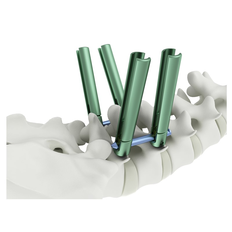 Top Quality Posterior Pedicle Screws Orthopedic Implants Titanium Material