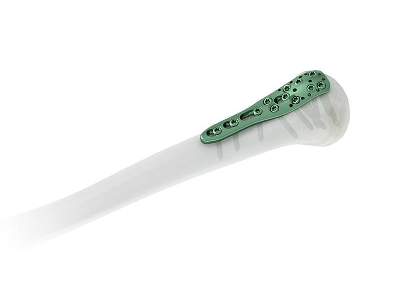 OEM Factory Orthopedic Implant Trauma Products