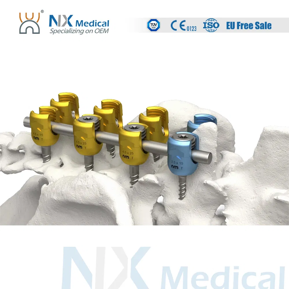 Nx Medical Orthopedic Implant Titanium Sf-III Spinal Pedicle Screw 5.5mm for Bone Fixation