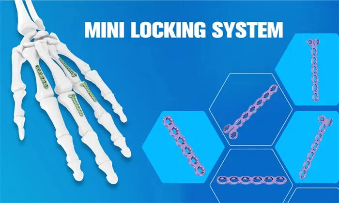 Orthopedic Implant Trauma Products