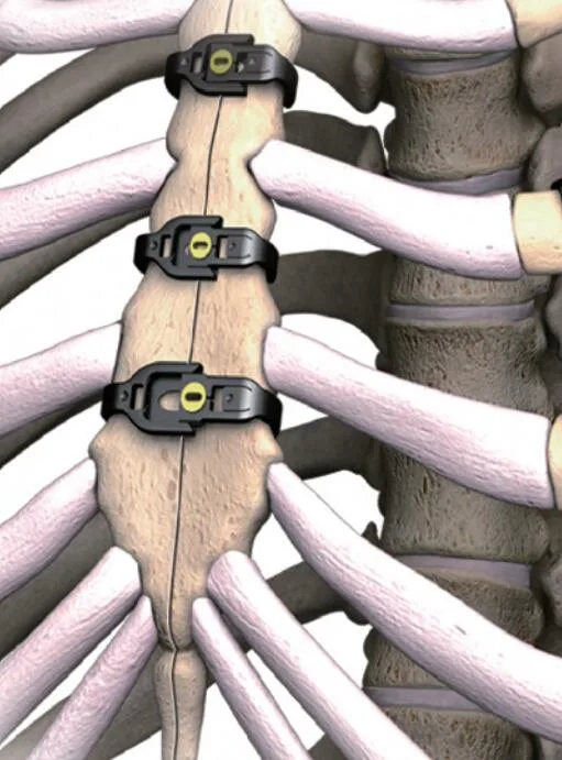 Sternal Closuare System, Sternalink, Itanium Alloy, Orthopedic Implant, Trauma, Surgical, Medical Instrument Set, with CE/ISO/FDA, Small Fragment, Large Fragmen