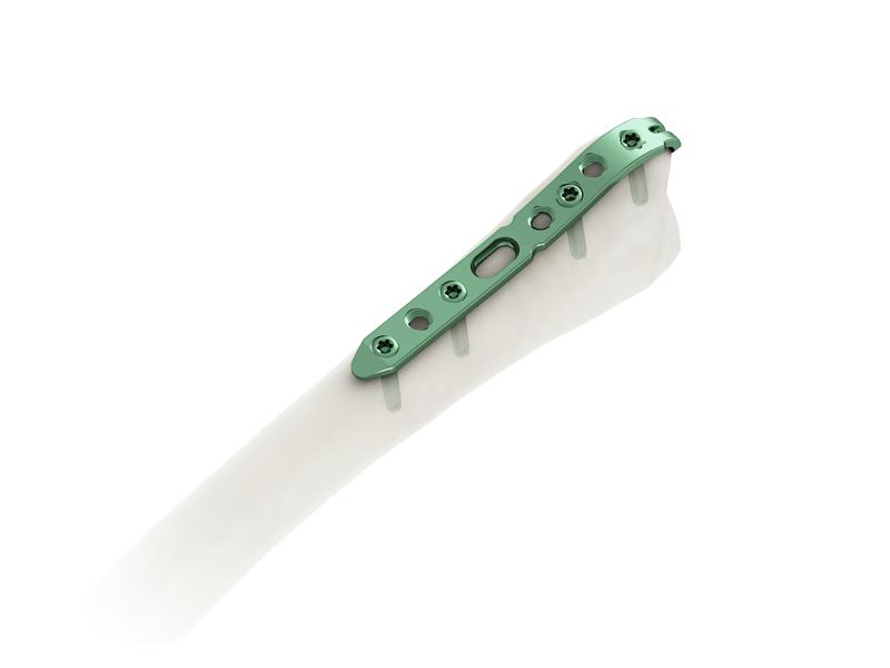 OEM Factory Orthopedic Implant Trauma Products