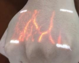 Varicose Management Clinical Grade IR Handheld