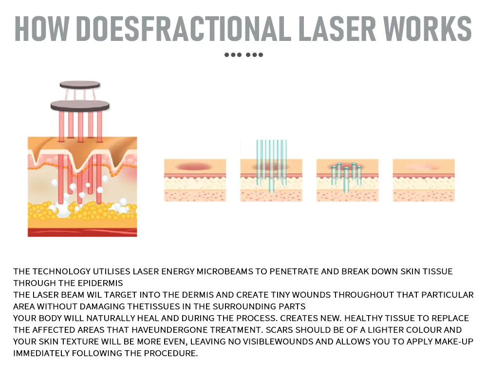 Laser CO2 Fractional