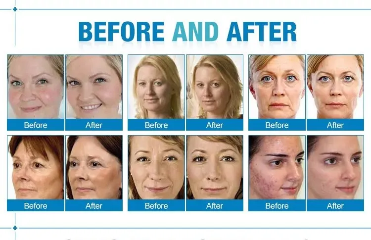 3 in 1 Hydro Microdermabrasion Treatment Display