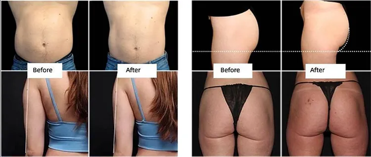 Slimming EMS Body Sculpting Machine Screen