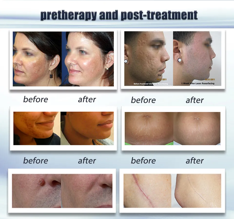 Professional C02 Vaginal Tightening Laser 70W 10600nm Skin Resurfacing CO2 Fractional Laser Machine