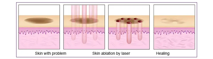 Fractional CO2 Laser Skin Resurfacing Principle
