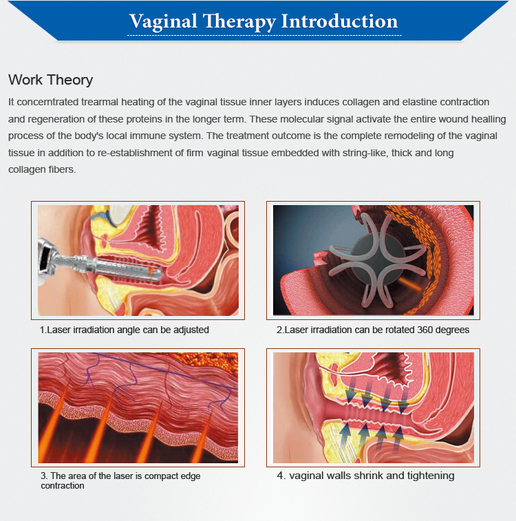 Fractional CO2 Laser Machine 60W Scar Removal Vaginal Tightening