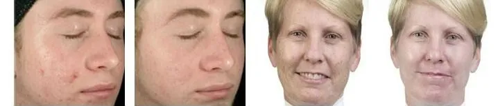 Hydro Dermabrasion Microdermabrasion Machine Diamond Hydra Beauty Facial Machine