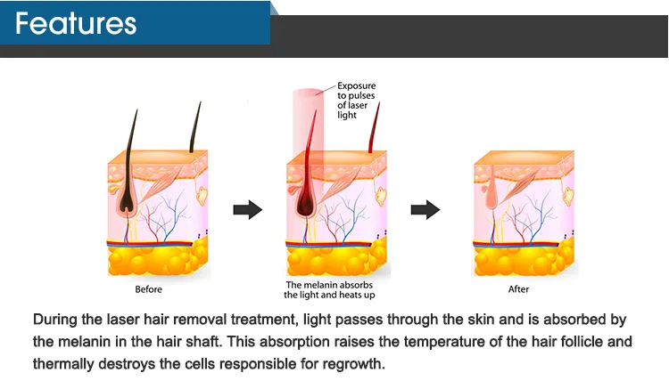 Diode Laser Hair Removal Wavelengths Medical Equipment