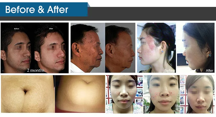 Factory-Direct CO2 Fractional Laser for Beauty Clinics and Spas