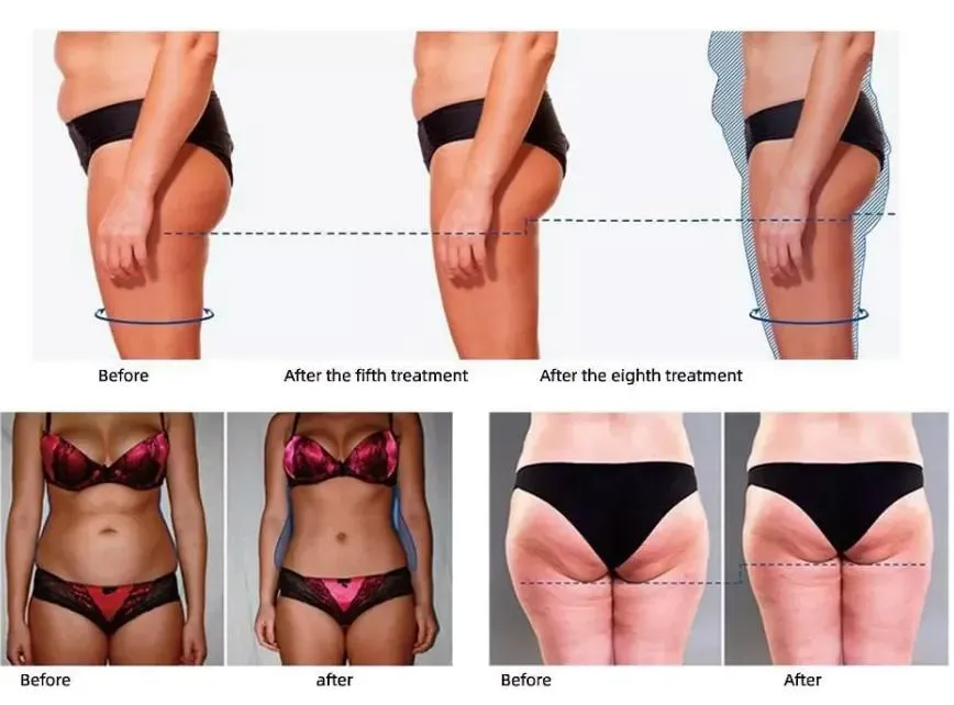 Body Sculpting Machine RF Skin Tightening Body Shape Scuplting Tightening Slimming Machine Venus Legacy Tratamiento Corporal