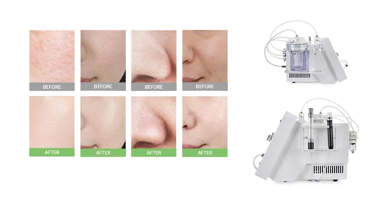 2 in 1 Hydro Microdermabrasion Aqua Peel Facial Machine View 3