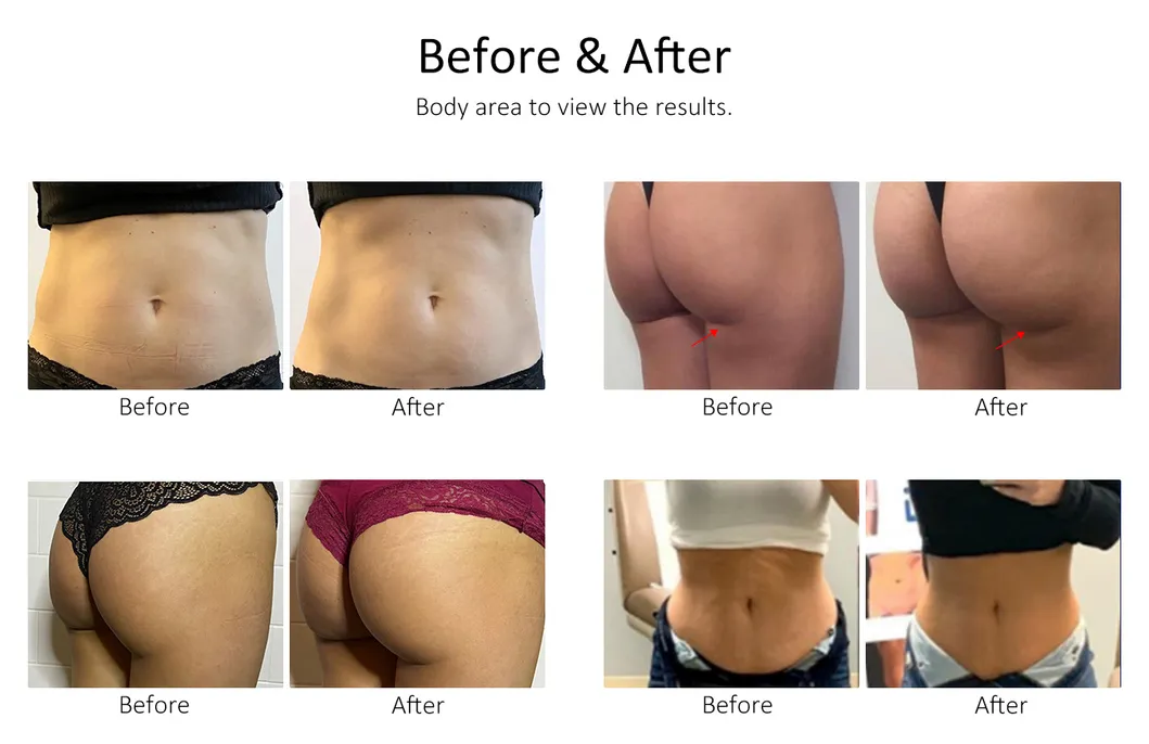 FDA Approved 15 Tesla EMS Body Sculpting Machine with RF Neo for Medical SPA and Clinic